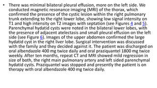 • There was minimal bilateral pleural effusion, more on the left side. We
conducted magnetic resonance imaging (MRI) of the thorax, which
confirmed the presence of the cystic lesion within the right pulmonary
trunk extending to the right lower lobe, showing low signal intensity on
T1 and high intensity on T2 images with septation (see Figures 4 and 5).
Parenchymal hydatid cysts were noted in the bilateral lower lobes, with
the presence of adjacent atelectasis and small pleural effusion on the left
side (see Figure 6). Images of the upper abdomen confirmed the large
hydatid cyst in the right liver lobe. Surgical intervention was discussed
with the family and they decided against it. The patient was discharged on
oral albendazole 400 mg twice daily and oral praziquantel 1800 mg twice
weekly. After ten months, repeat CT and MRI showed mild regression in
size of both, the right main pulmonary artery and left sided parenchymal
hydatid cysts. Praziquantel was stopped and presently the patient is on
therapy with oral albendazole 400 mg twice daily.
 