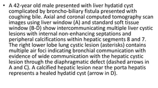 • A 42-year old male presented with liver hydatid cyst
complicated by broncho-biliary fistula presented with
coughing bile. Axial and coronal computed tomography scan
images using liver window (A) and standard soft tissue
window (B-D) show intercommunicating multiple liver cystic
lesions with internal non-enhancing septations and
peripheral calcifications within hepatic segments 8 and 7.
The right lower lobe lung cystic lesion (asterisks) contains
multiple air foci indicating bronchial communication with
evidence of wide communication with the hepatic cystic
lesion through the diaphragmatic defect (dashed arrows in
A and C). A calcified hepatic lesion near the porta hepatis
represents a healed hydatid cyst (arrow in D).
 