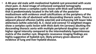 • A 48-year old male with mediastinal hydatid cyst presented with acute
chest pain. A: Axial image of enhanced computed tomography
angiogram shows a complex cystic lesion with thick wall (white arrows)
that is predominately located in the left side of the posterior
mediastinum with evidence small calcifications at the periphery of the
lesions at the site of abutment with descending thoracic aorta. There is
adjacent pleural effusion (white asterisk) and enhancing left lower lobe
atelectasis (white asterisk); B, C: Axial and coronal T2 weighted images
show a complex cystic lesion with thick dark rim (arrows) abutting the
descending thoracic aorta with multiple peripheral daughter cysts of
higher signal intensity compared to the intermediately hyperintenese
matrix of the mother cyst. Magnetic resonance imaging findings are
highly suggestive of hydatid cyst, likely primary given absence of
evidence of lung and liver hydatid disease.
 
