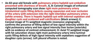 • An 82-year-old female with pulmonary artery hydatid cyst embolism
presented with shortness of breath. A, B: Coronal images of enhanced
computed tomography scan show right main pulmonary artery
intraluminal cystic filling defects causing expansion and near occlusion
of the artery with extension into the right interlobar pulmonary artery
(white arrows). There is hepatic hydatid cyst with internal septation and
daughter cysts and scattered wall calcifications (black arrows); C:
Coronal image of T1 weighted magnetic resonance angiography
confirms the presence of filling defect of low signal intensity within the
right pulmonary artery and low signal intensity liver lesion (asterisks)
with no evidence of contrast enhancement; D: Axial T2 weighted image
with fat saturation shows right main pulmonary artery intra-luminal
cystic filling defects of high signal intensity with septations suggestive of
daughter cysts (arrow). Left pleural effusion is noted.
 