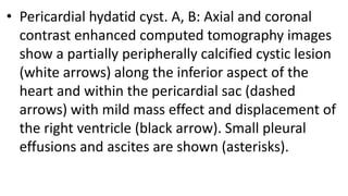 • Pericardial hydatid cyst. A, B: Axial and coronal
contrast enhanced computed tomography images
show a partially peripherally calcified cystic lesion
(white arrows) along the inferior aspect of the
heart and within the pericardial sac (dashed
arrows) with mild mass effect and displacement of
the right ventricle (black arrow). Small pleural
effusions and ascites are shown (asterisks).
 