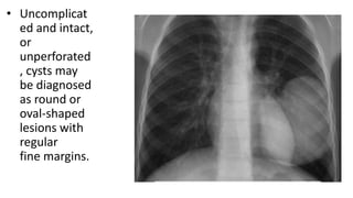 • Uncomplicat
ed and intact,
or
unperforated
, cysts may
be diagnosed
as round or
oval-shaped
lesions with
regular
fine margins.
 