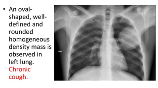 • An oval-
shaped, well-
defined and
rounded
homogeneous
density mass is
observed in
left lung.
Chronic
cough.
 