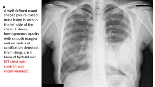 •A well-defined round
shaped pleural based
mass lesion is seen in
the left side of the
chest, It shows
homogeneous opacity
with smooth margins
and no matrix of
calcification detected,
the findings are in
favor of hydatid cyst
(CT chest with
contrast was
recommended).
 