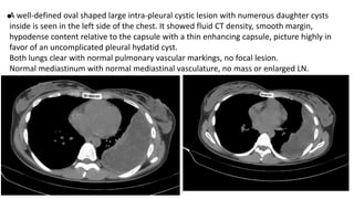 •A well-defined oval shaped large intra-pleural cystic lesion with numerous daughter cysts
inside is seen in the left side of the chest. It showed fluid CT density, smooth margin,
hypodense content relative to the capsule with a thin enhancing capsule, picture highly in
favor of an uncomplicated pleural hydatid cyst.
Both lungs clear with normal pulmonary vascular markings, no focal lesion.
Normal mediastinum with normal mediastinal vasculature, no mass or enlarged LN.
 