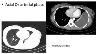 • Axial C+ arterial phase
Axial lung window
 