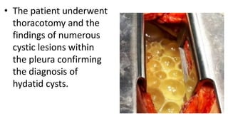 • The patient underwent
thoracotomy and the
findings of numerous
cystic lesions within
the pleura confirming
the diagnosis of
hydatid cysts.
 
