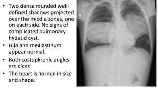 • Two dense rounded well-
defined shadows projected
over the middle zones, one
on each side. No signs of
complicated pulmonary
hydatid cyst.
• Hila and mediastinum
appear normal.
• Both costophrenic angles
are clear.
• The heart is normal in size
and shape.
 