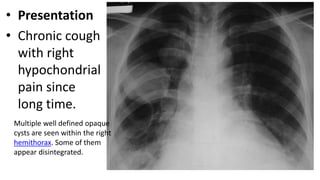 • Presentation
• Chronic cough
with right
hypochondrial
pain since
long time.
Multiple well defined opaque
cysts are seen within the right
hemithorax. Some of them
appear disintegrated.
 