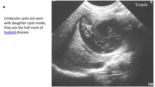 •
Unilocular cysts are seen
with daughter cysts inside,
they are the hall mark of
hydatid disease.
 