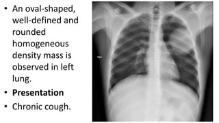 • An oval-shaped,
well-defined and
rounded
homogeneous
density mass is
observed in left
lung.
• Presentation
• Chronic cough.
 