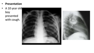 • Presentation
• A 10 year old
boy
presented
with cough.
 