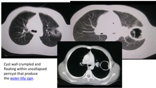 Cyst wall crumpled and
floating within uncollapsed
pericyst that produce
the water-lilly sign.
 