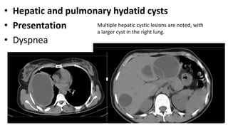 • Hepatic and pulmonary hydatid cysts
• Presentation
• Dyspnea
Multiple hepatic cystic lesions are noted, with
a larger cyst in the right lung.
 