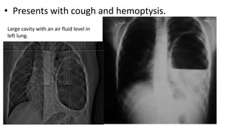 • Presents with cough and hemoptysis.
Large cavity with an air fluid level in
left lung.
 