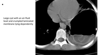•
Large cyst with an air-fluid
level and crumpled laminated
membrane lying dependently
 