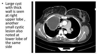 • Large cyst
with thick
wall is seen
at right
upper lobe ,
another
small cystic
lesion also
noted at
lower lobe of
the same
side
 