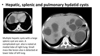 • Hepatic, splenic and pulmonary hydatid cysts
Multiple hepatic cysts with a large
splenic cyst are seen. A
complicated cyst also is noted at
medial lobe of right lung. Small
mass-like lesion also is detected at
lower lobe of left lung.
 