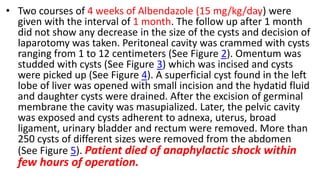 • Two courses of 4 weeks of Albendazole (15 mg/kg/day) were
given with the interval of 1 month. The follow up after 1 month
did not show any decrease in the size of the cysts and decision of
laparotomy was taken. Peritoneal cavity was crammed with cysts
ranging from 1 to 12 centimeters (See Figure 2). Omentum was
studded with cysts (See Figure 3) which was incised and cysts
were picked up (See Figure 4). A superficial cyst found in the left
lobe of liver was opened with small incision and the hydatid fluid
and daughter cysts were drained. After the excision of germinal
membrane the cavity was masupialized. Later, the pelvic cavity
was exposed and cysts adherent to adnexa, uterus, broad
ligament, urinary bladder and rectum were removed. More than
250 cysts of different sizes were removed from the abdomen
(See Figure 5). Patient died of anaphylactic shock within
few hours of operation.
 