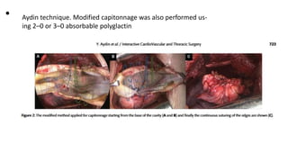 • Aydin technique. Modified capitonnage was also performed us-
ing 2–0 or 3–0 absorbable polyglactin
 