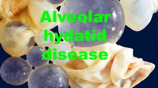 Alveolar
hydatid
disease
 