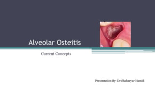 Alveolar Osteitis
Current Concepts
Presentation By: Dr.Shaharyar Hamid
 