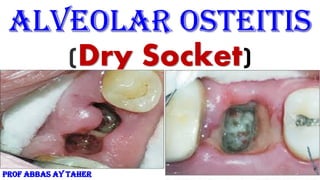 Alveolar Osteitis
(Dry Socket)
PROF ABBAS AY TAHER
 