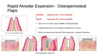 Maxilla Rotation Device Alveolar Resorbtion | ODP