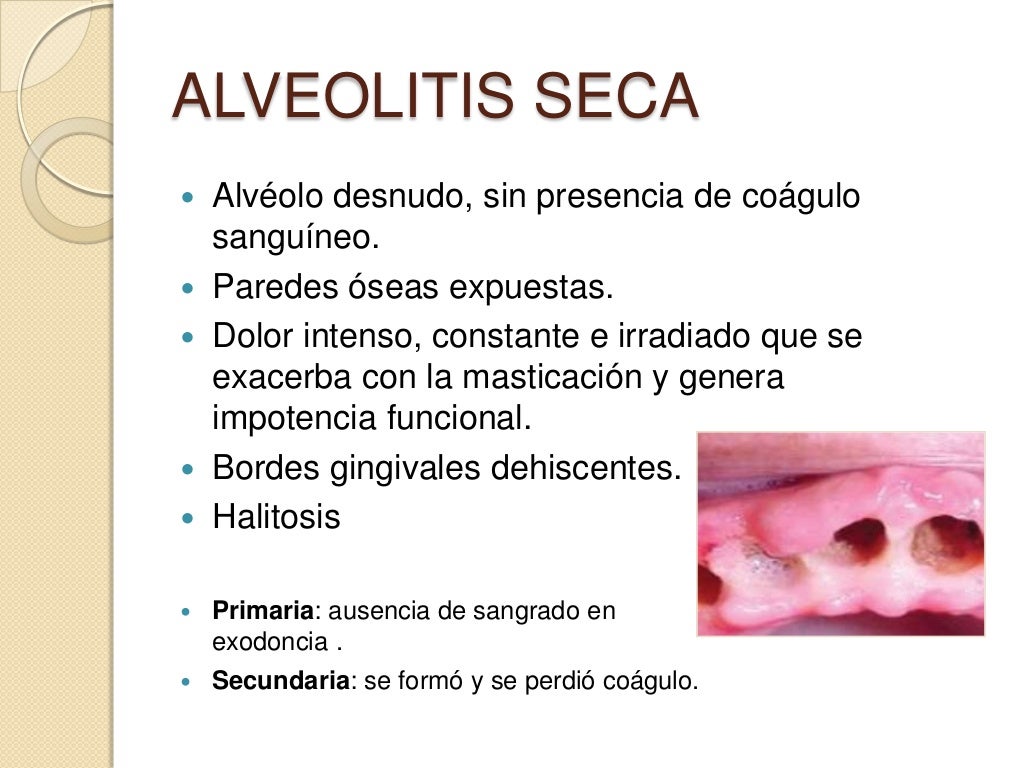 Alveolitis