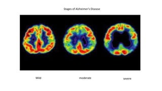 Stages of Alzheimer’s Disease
Mild moderate severe
 