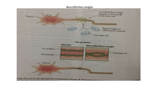 Neurofibrillary tangles
 