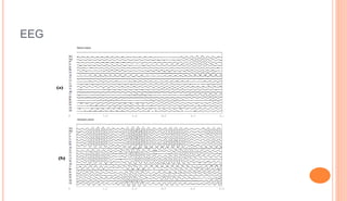 EEG
 