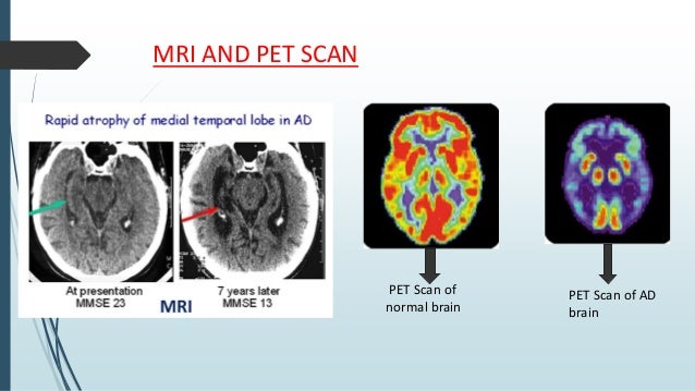 Alzeihmer Disease