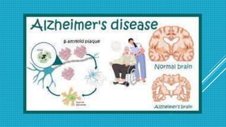 alzeimer's disease.pptx