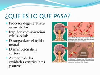 ¿QUE ES LO QUE PASA?Procesos degenerativos aumentados. Impiden comunicación célula-célulaDesorganizan el tejido neuralDisminución de la cortezaAumento de las cavidades ventriculares  y surcos.