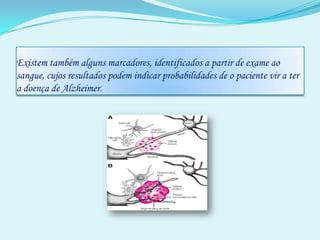 Existem também alguns marcadores, identificados a partir de exame ao sangue, cujos resultados podem indicar probabilidades de o paciente vir a ter a doença de Alzheimer. 