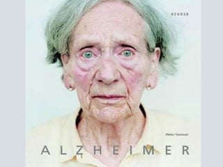 De evolución lenta; comienza con pequeños olvidos y termina en daño cerebral grave.