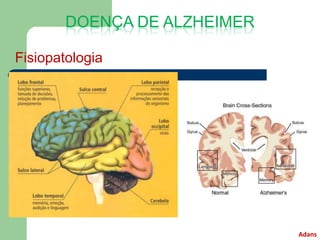 DOENÇA DE ALZHEIMER

Fisiopatologia




                              Adans
 