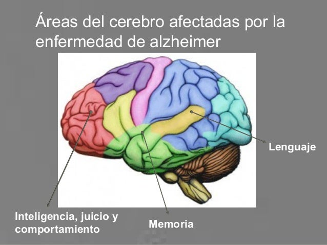 Resultado de imagen para alzheimer