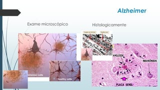 Exame microscópico Histologicamente
Alzheimer
 