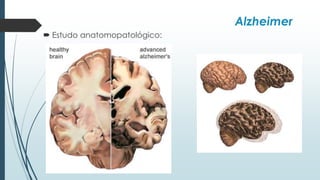 Alzheimer
 Estudo anatomopatológico:
 