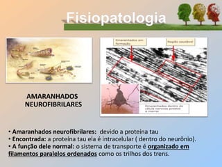AMARANHADOS
NEUROFIBRILARES
• Amaranhados neurofibrilares: devido a proteína tau
• Encontrada: a proteína tau ela é intracelular ( dentro do neurônio).
• A função dele normal: o sistema de transporte é organizado em
filamentos paralelos ordenados como os trilhos dos trens.
 