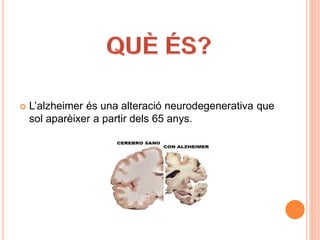  L’alzheimer és una alteració neurodegenerativa que
sol aparèixer a partir dels 65 anys.
 