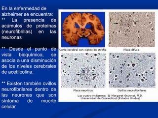 En la enfermedad de
alzheimer se encuentra:
** La presencia de
acúmulos de proteínas
(neurofibrillas) en las
neuronas
** Desde el punto de
vista bioquímico, se
asocia a una disminución
de los niveles cerebrales
de acetilcolina.
** Existen también ovillos
neurofibrilares dentro de
las neuronas que son
síntoma de muerte
celular
 