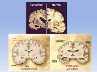 HEALTHY BRAIN
BRAIN WITH
ALZHEIMER
 