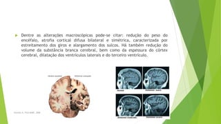  Dentre as alterações macroscópicas pode-se citar: redução do peso do
encéfalo, atrofia cortical difusa bilateral e simétrica, caracterizada por
estreitamento dos giros e alargamento dos sulcos. Há também redução do
volume da substância branca cerebral, bem como da espessura do córtex
cerebral, dilatação dos ventrículos laterais e do terceiro ventrículo.
Sereniki A, Vital MABF, 2008 13
 