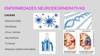ENFERMEDADES NEURODEGENERATIVAS
CAUSAS
-Desconocidas
-Genéticas
-Virus, toxinas
-Alcoholismo
-Tumores
-Ataques cerebrovasculares
 