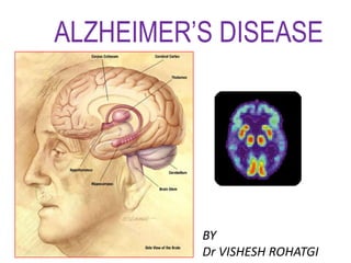 ALZHEIMER’S DISEASE
BY
Dr VISHESH ROHATGI
 