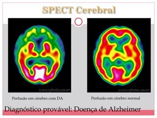 Perfusão em cérebro com DA Perfusão em cérebro normal
Diagnóstico provável: Doença de Alzheimer
 