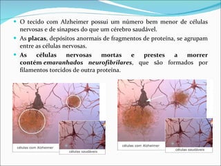 O tecido com Alzheimer possui um número bem menor de células nervosas e de sinapses do que um cérebro saudável. As  placas , depósitos anormais de fragmentos de proteína, se agrupam entre as células nervosas. As células nervosas mortas e prestes a morrer contém  emaranhados neurofibrilares , que são formados por filamentos torcidos de outra proteína. 